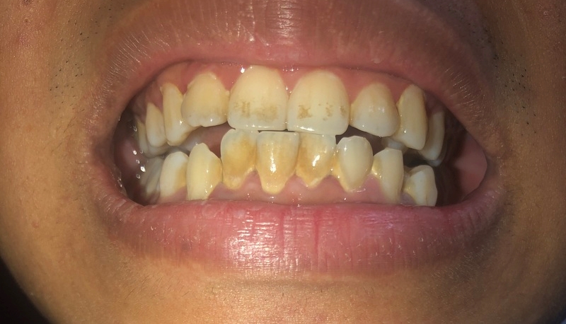 Răng ố vàng có ảnh hưởng như nào?