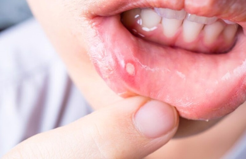 Các triệu chứng của nhiệt miệng là gì? 