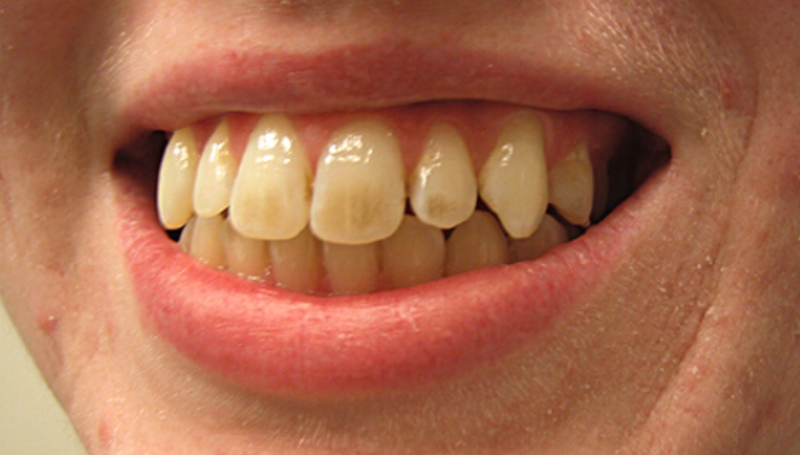 Răng ố vàng là gì?