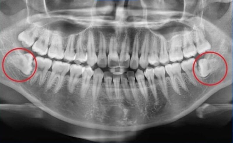 Răng mọc kẹt trong xương hàm