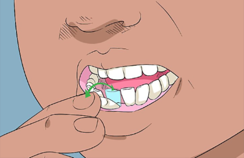 Nhổ răng tại nhà có thực sự an toàn?