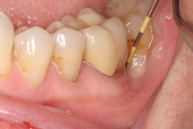 Viêm chân răng hàm có nguy hiểm không?
