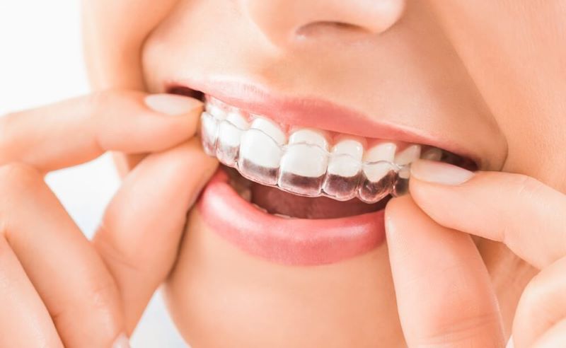 Nguyên lý tác động của niềng răng trong suốt