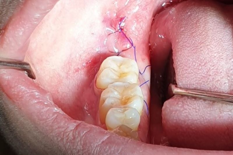 Điều trị nhiễm trùng sau nhổ răng