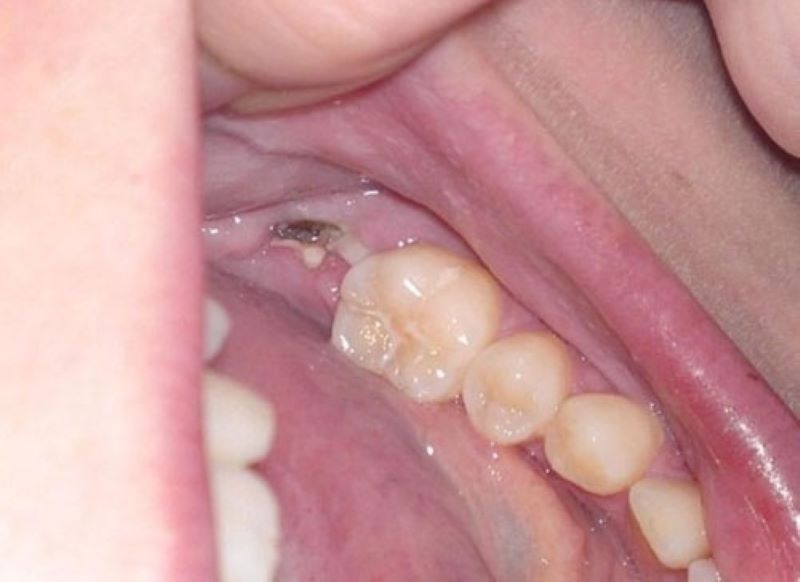 Màng trắng sau khi nhổ răng là gì