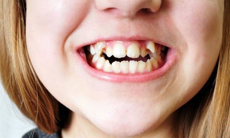 Răng khểnh là gì?