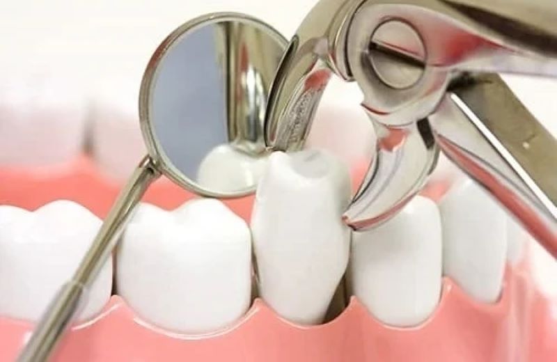 Nhổ răng số 4 có ảnh hưởng gì không?