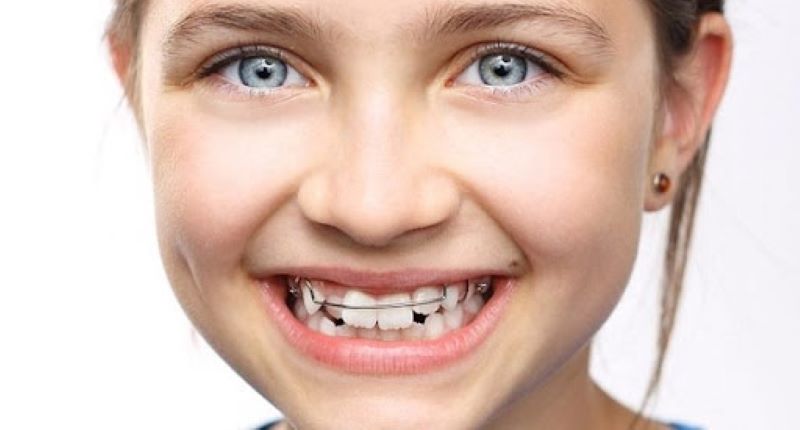 Có nên niềng răng cho trẻ không?