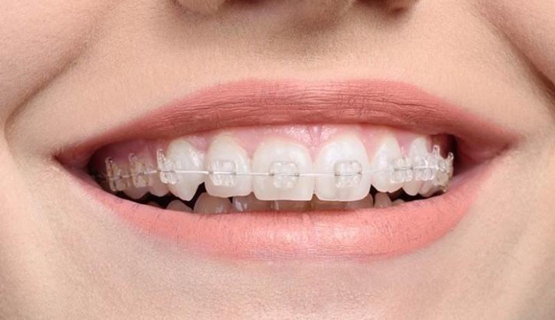 Niềng răng khểnh có tác hại gì không? 