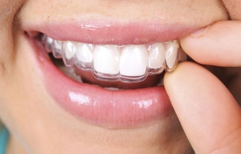Niềng răng trong suốt có đáng lựa chọn?