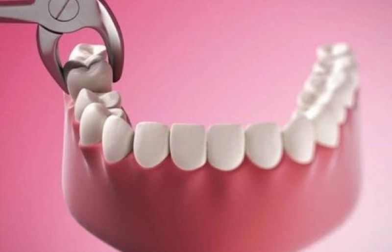 Trường hợp nào thì cần nhổ răng?