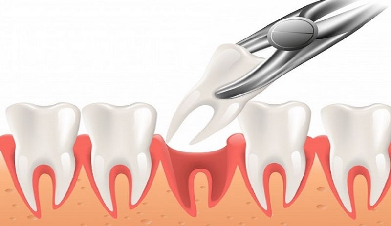 Các phương pháp khắc phục sau khi nhổ răng số 6 hàm trên