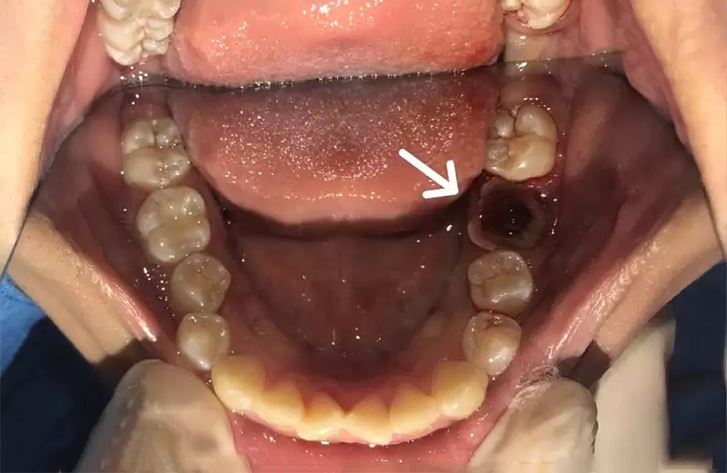 Nhổ răng hàm trên trong cùng bị sâu liệu có đau?
