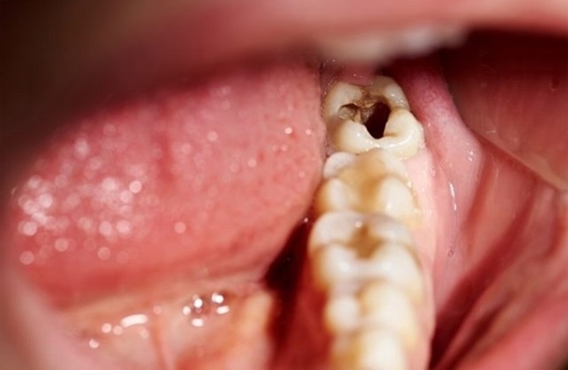 Khi nào cần nhổ răng số 8?