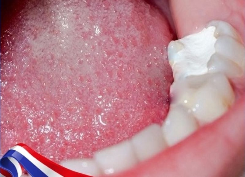Trám răng tại nhà có ảnh hưởng gì không?
