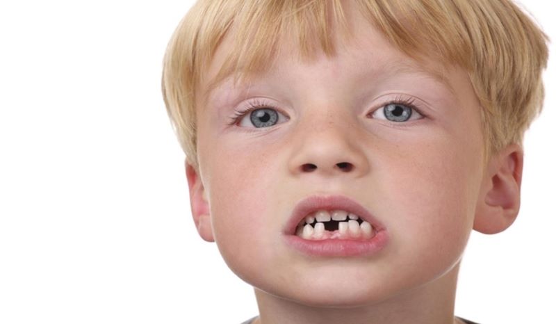 Những lưu ý khi trẻ thay răng