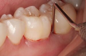 Viêm chân răng hàm