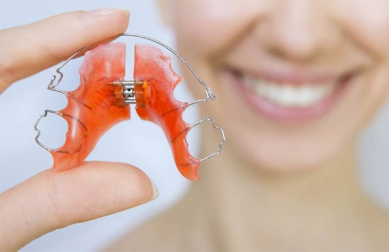 Hàm duy trì có tác dụng gì trong niềng răng