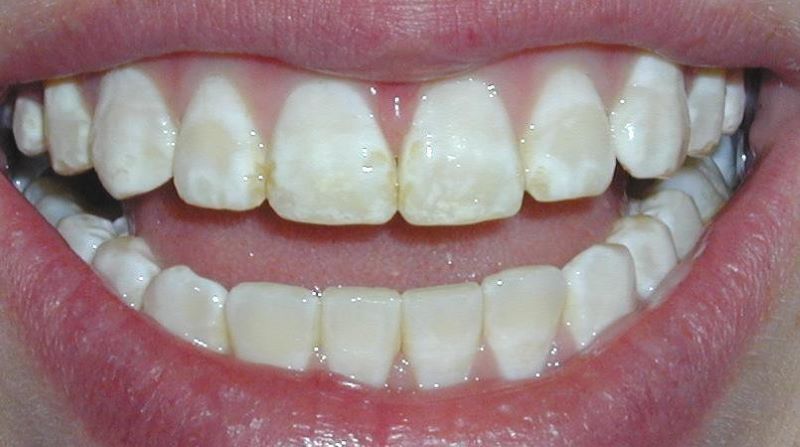 Men răng có vai trò gì với răng