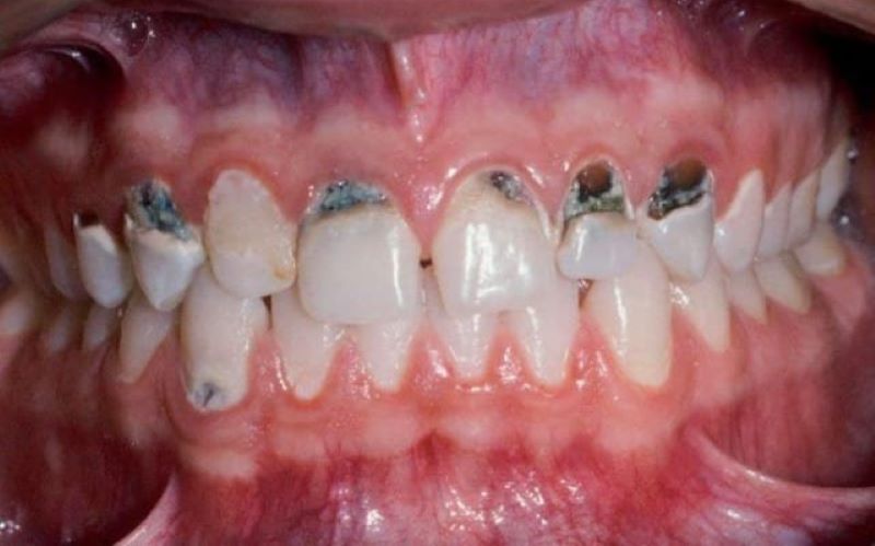 Tác hại của cao răng đen