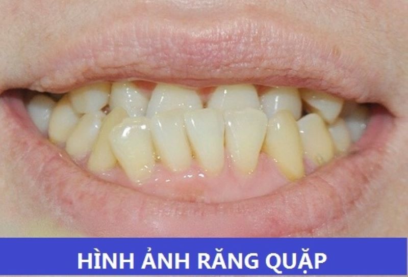 Răng quặp là răng như thế nào