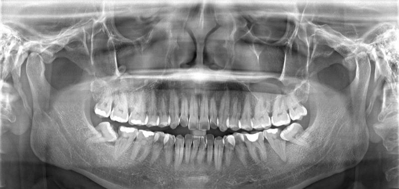 Những trường hợp điều trị nào thì cần phải chụp x quang răng?