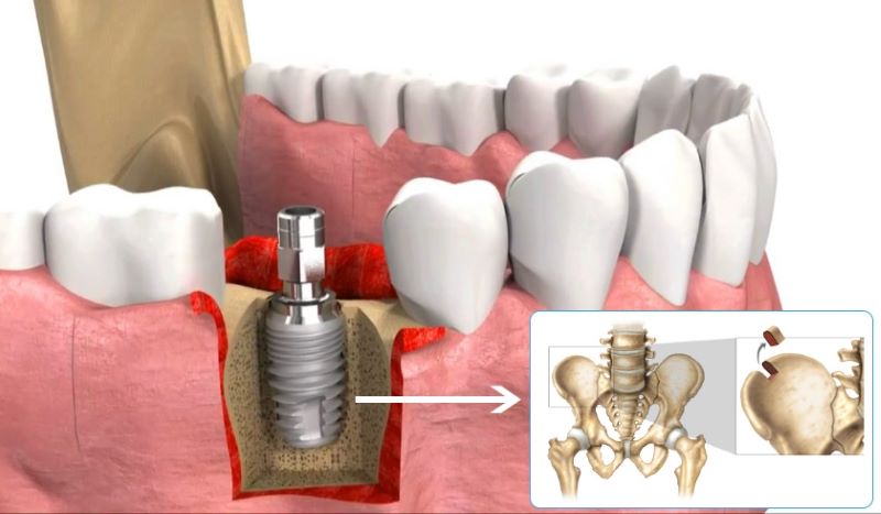 Chữa tiêu xương răng bằng cách ghép xương