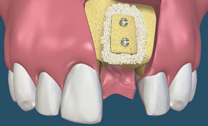 Các kỹ thuật ghép xương răng cơ bản.