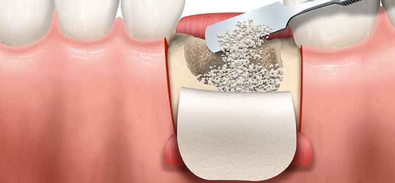 Trường hợp nào thì phải ghép xương răng?