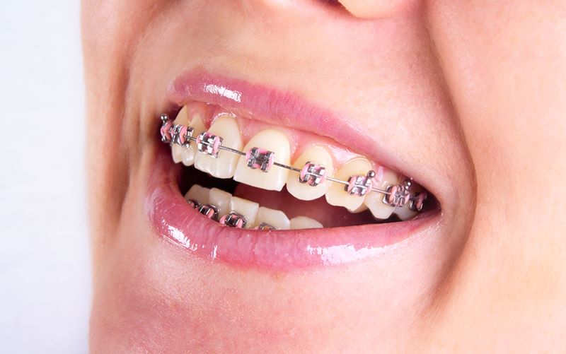 Đối tượng nào nên nắn chỉnh răng?
