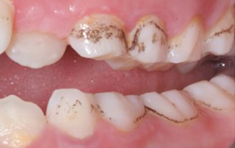 Nguyên nhân răng bị đốm đen