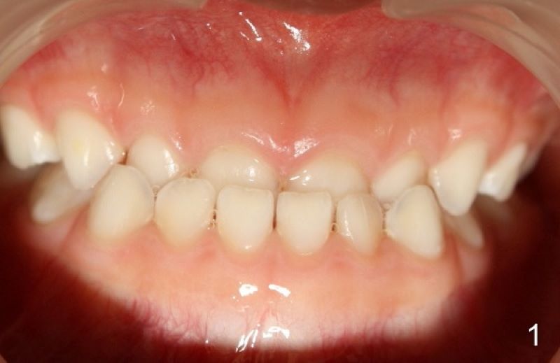 Những ảnh hưởng của răng quặp.