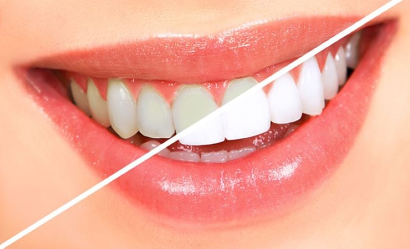 Một số cách khắc phục răng nhiễm fluor