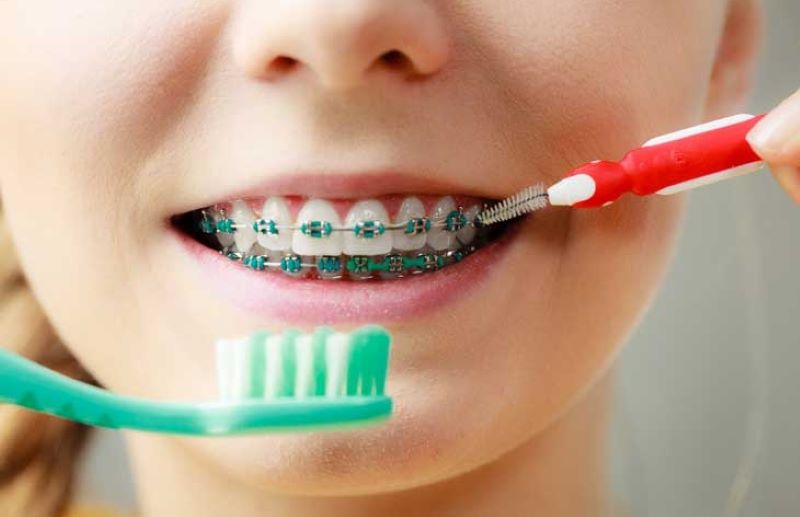 Cách chăm sóc răng miệng khi đeo mắc cài pha lê