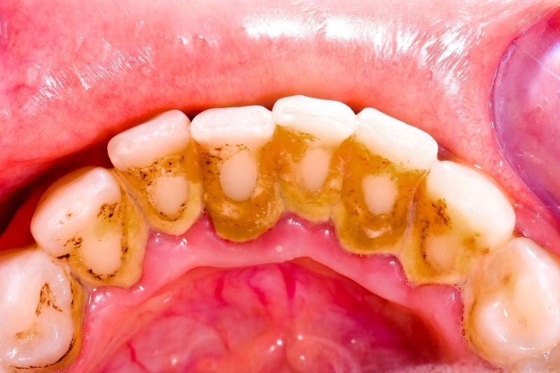 Mảng bám răng