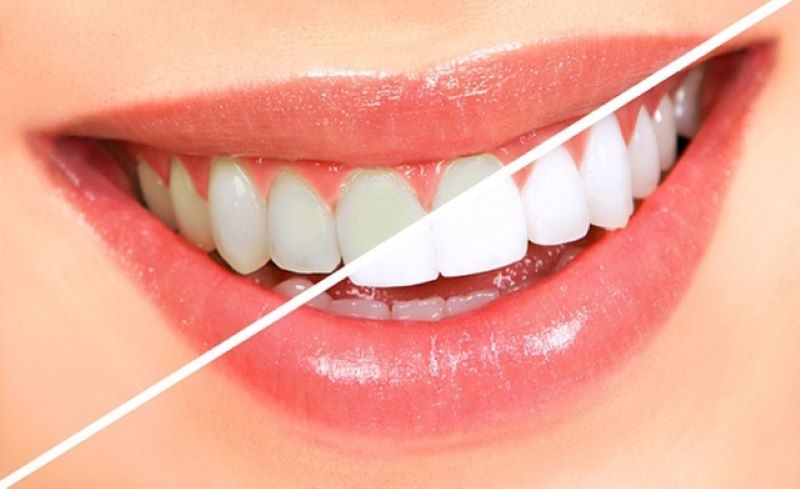 Cách trị chân răng bị đen tại nhà bằng kem tẩy trắng răng